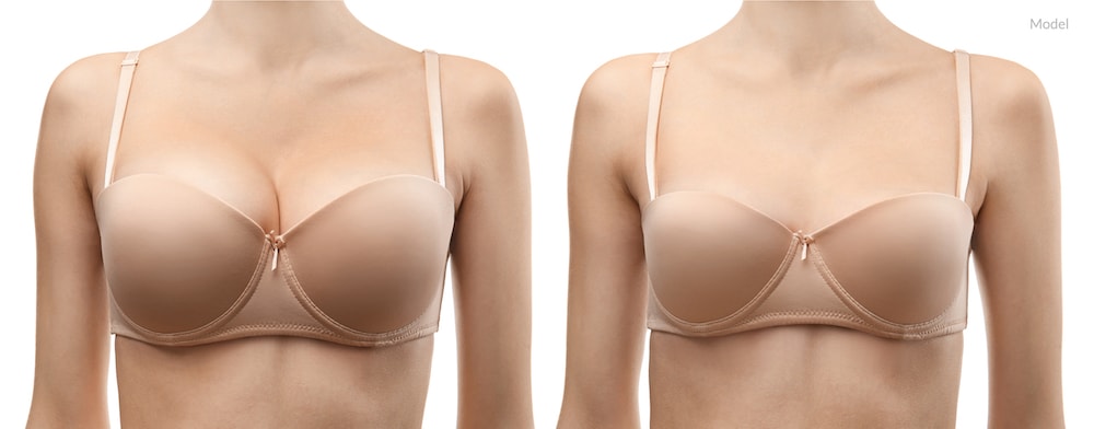 Image of a model before and after a breast reduction surgery.