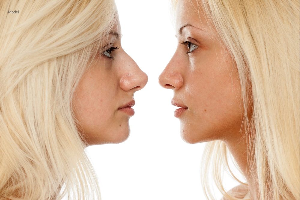 Side by side comparison of a woman before and after a rhinoplasty procedure.