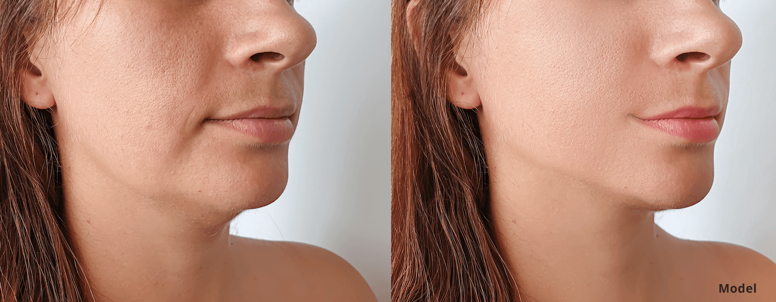 Everything You Need to Know About Chin Liposuction PSC Atlanta