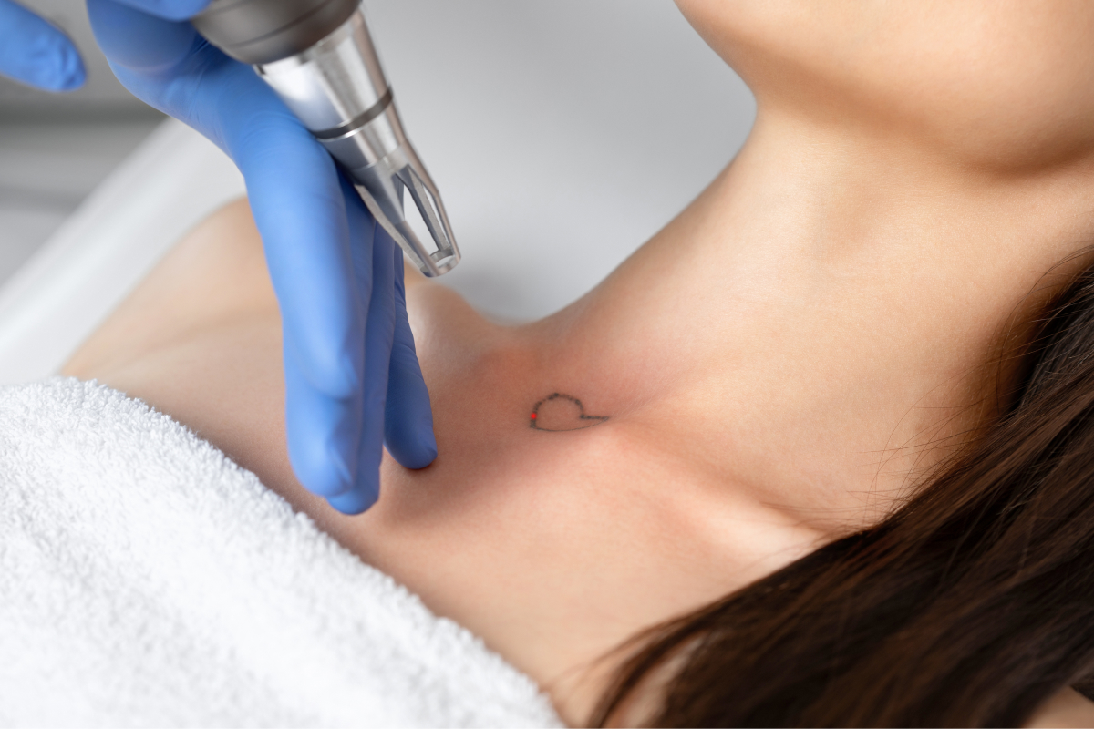Understanding Laser Tattoo Removal Cost - Atlanta