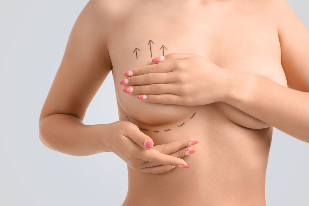 Close-up of female torso with surgical markings illustrating types of breast lifts and incision planning before mastopexy procedure.