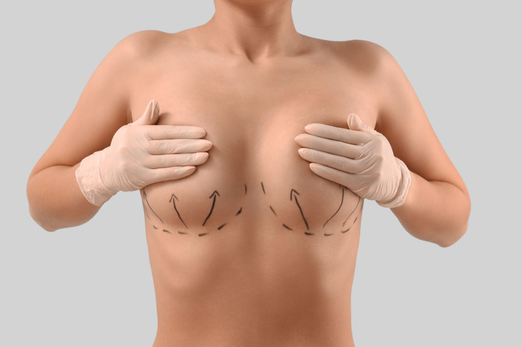 Surgical markings with lift arrows on breasts illustrating breast lift vs breast implants comparison.